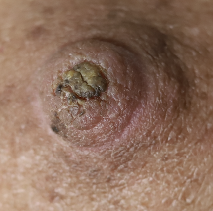 hyperkeratosis of nipple